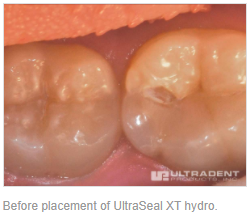 Before placement of UltraSealXT hydro.