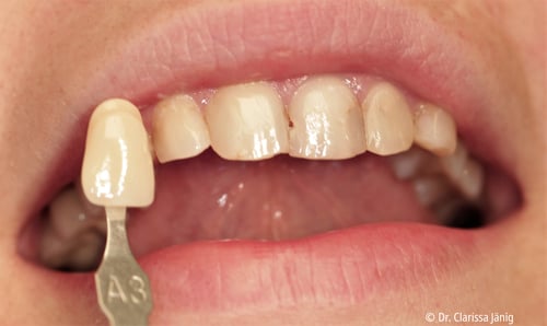 7_situation after Endo whitening