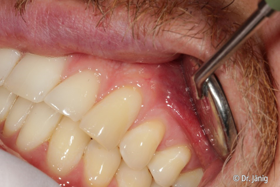 Enamelast™ fluoride varnish Combining an excellent fluoride release