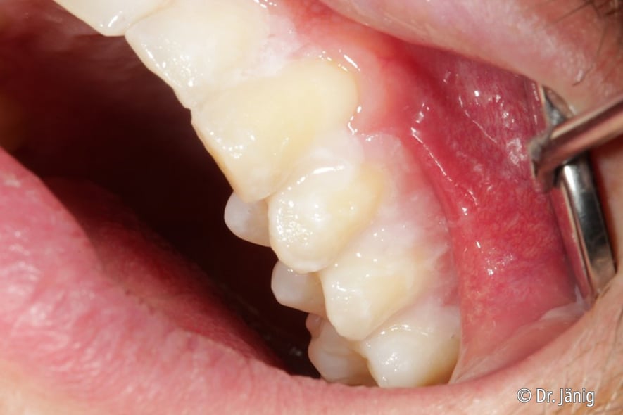 Enamelast™ fluoride varnish Combining an excellent fluoride release