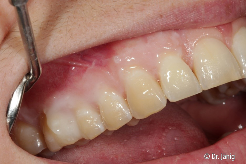 Enamelast™ fluoride varnish Combining an excellent fluoride release