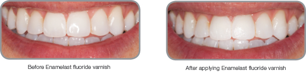 Before-After_Enamelast