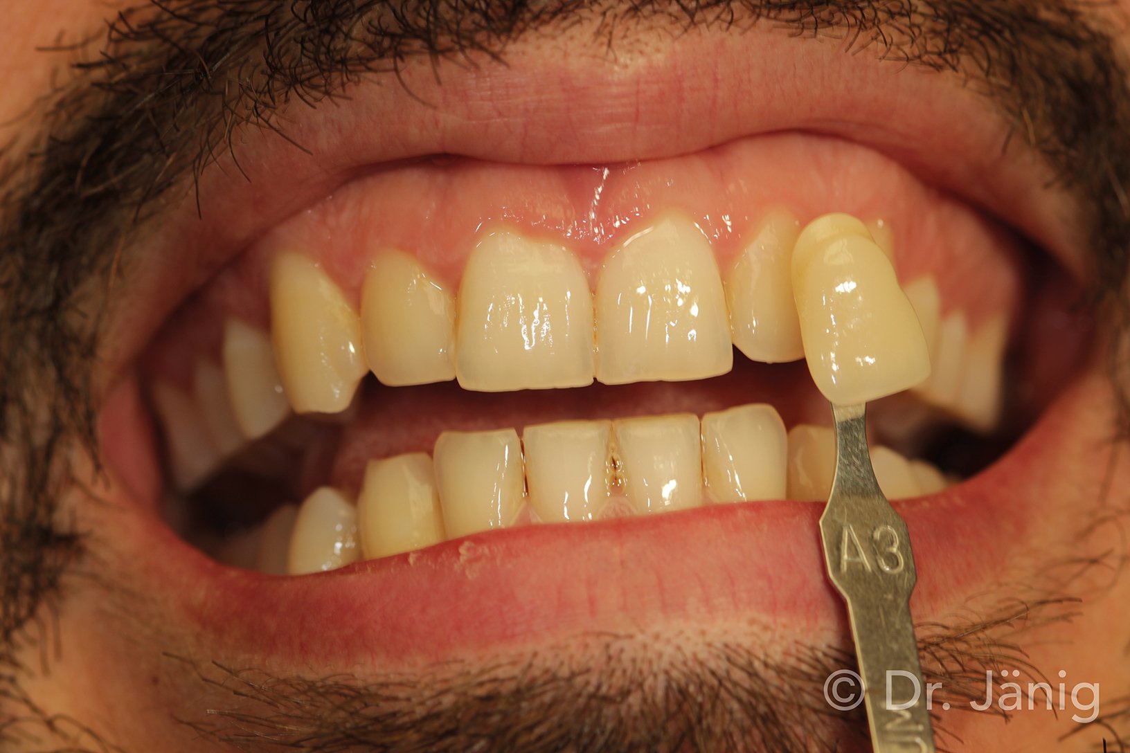 Fig.3_Determination of tooth shade_©Dr. Jänig
