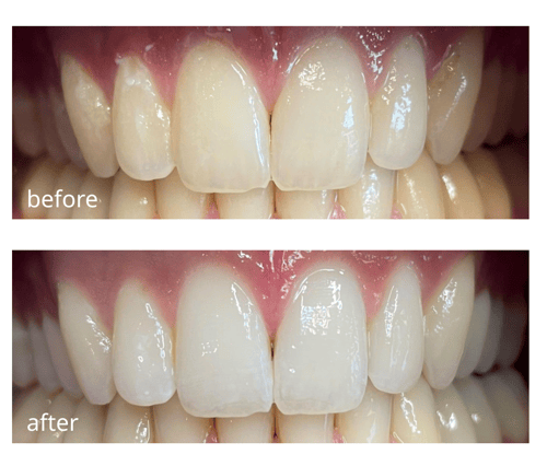 Opalescence Go_Before and after_EN