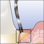 tm_technique_step-1_c2a9ultradent-products-2019 (1)