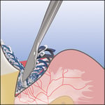 tm_technique_step-4_c2a9ultradent-products-2019