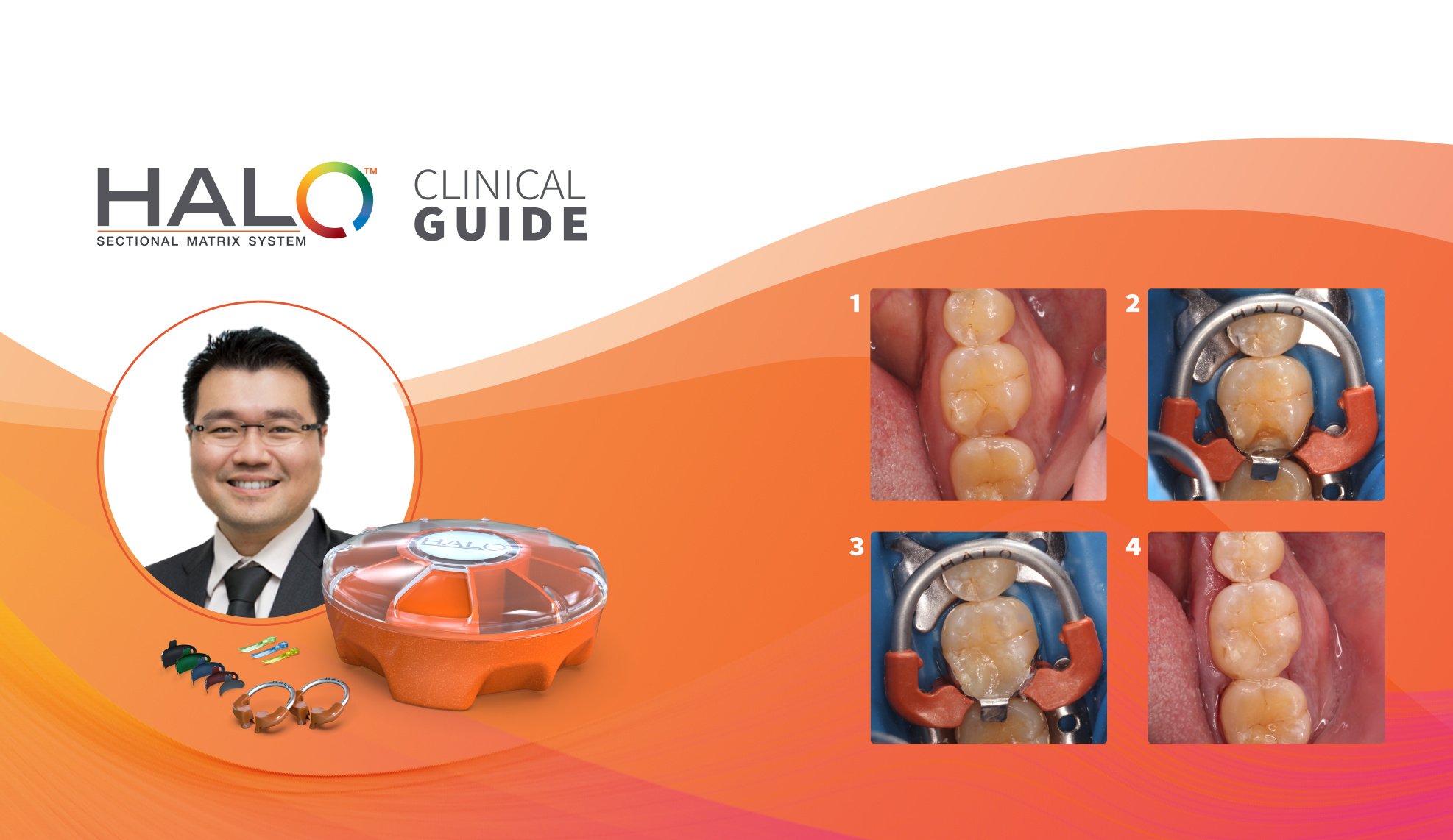 Clinical Guide: Class II Composite Replacement of Chipped Filling