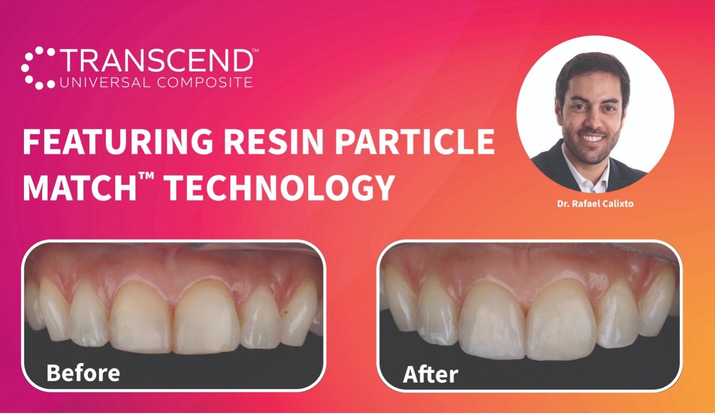 Clinical Guide: Class II Restoration of Maxillary Central Incisors