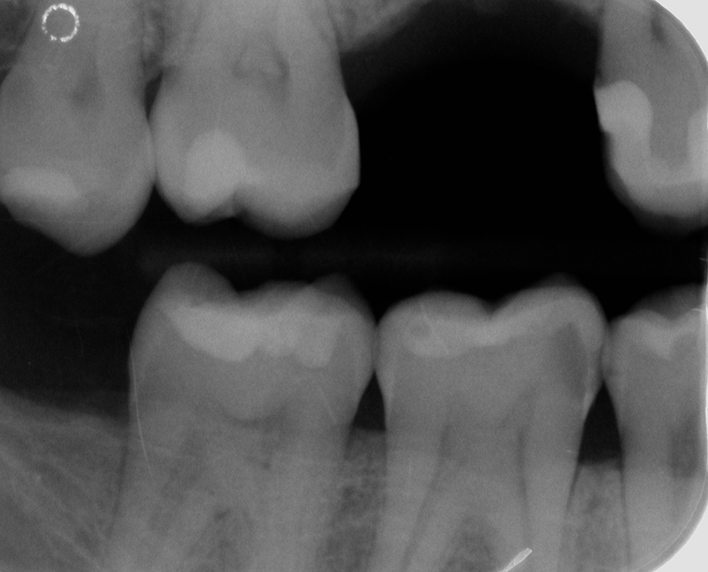 6-rx-bite