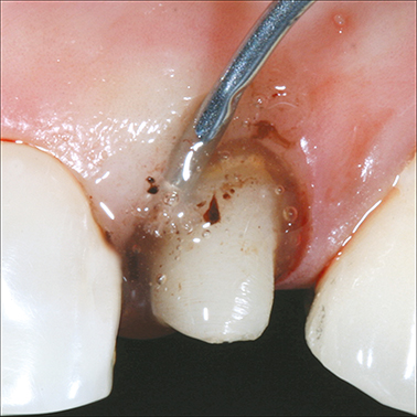 metal-dento-infusor-tip_hemostatic