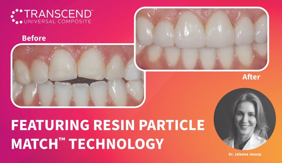 Clinical Guide: No-Prep Composite Veneers, Teeth #13–23